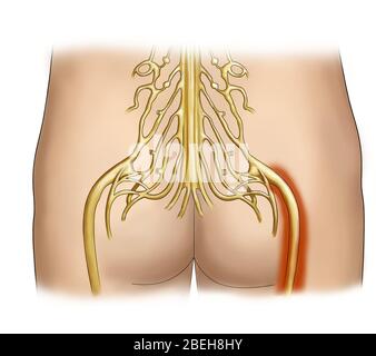 Sciatic Nerve Pain, Illustration Stock Photo