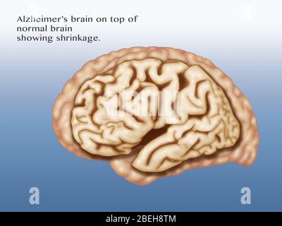 Alzheimer's and Normal Brains, Comparison Stock Photo