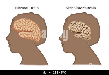 Alzheimer's and Normal Brains, Comparison Stock Photo