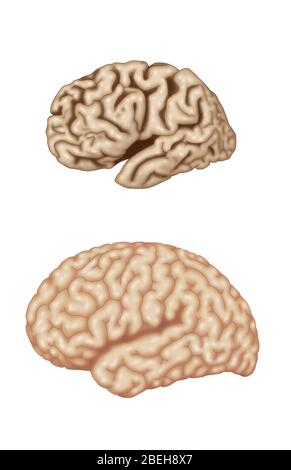 Alzheimer's and Normal Brains, Comparison Stock Photo