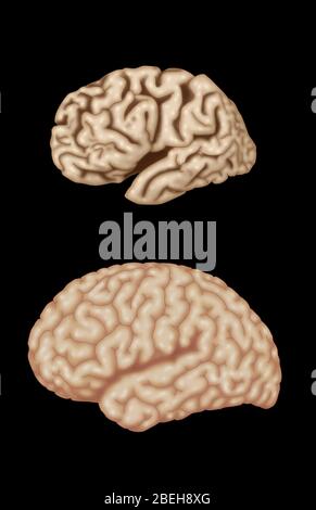 Alzheimer's and Normal Brains, Comparison Stock Photo