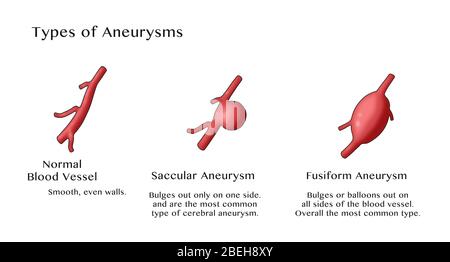 Types of Aneurysms Stock Photo - Alamy