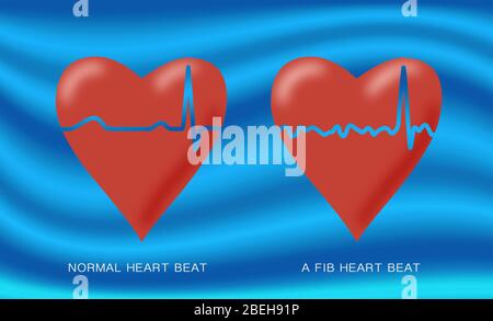 Normal and AFib heartbeats, Illustration Stock Photo