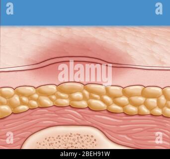 Pressure Sore, Stage 1 Stock Photo