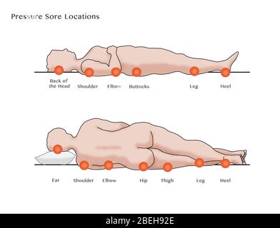 Pressure Sore Locations, Diagram Stock Photo - Alamy