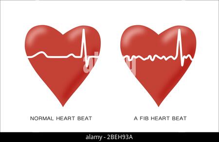 Normal and AFib heartbeats, Illustration Stock Photo