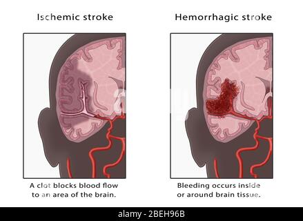 Ischemic & Hemorrhagic Stroke, Illustration Stock Photo - Alamy