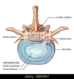 An illustration of a posterolateral herniation of an intervertebral disk in the lumbar spine.  Individuals suffer from a herniated disk when the outer fibrous tissue of the disk, known as the anulus fibrosus, can rupture due to trauma or old age.  As a result, the gel-like center of the disk protrudes outward and compresses the nerves in the back, weakening muscles and causing severe local back pain. Stock Photo