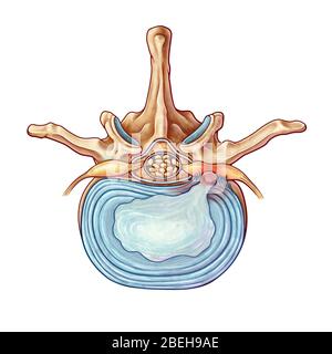 Herniated Disk, illustration Stock Photo - Alamy