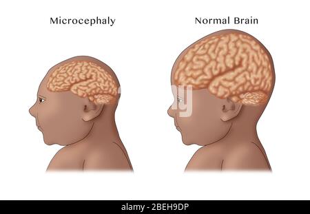 Microcephaly, Illustration Stock Photo