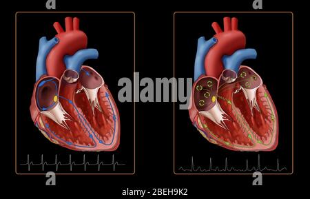 Heart, Atrial Fibrillation and EKGs, Illustration Stock Photo