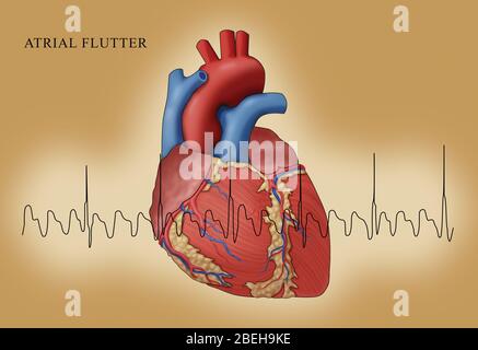 Atrial Flutter with EKG, Illustration Stock Photo - Alamy