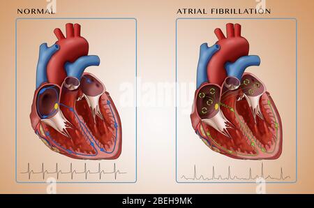 Heart, Atrial Fibrillation and EKGs, Illustration Stock Photo