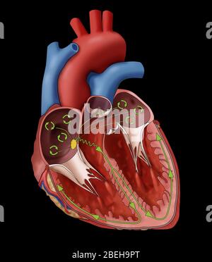 Illustration showing a heart with atrial fibrillation (AFib), a heart rhythm abnormality. As shown here, the electrical impulses (green circles) are spread through the atria in a chaotic fashion causing the heart to beat in a rapid disorganized manner. Stock Photo