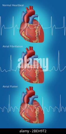 Heart, AFib and Atrial Flutter, Illustration Stock Photo - Alamy