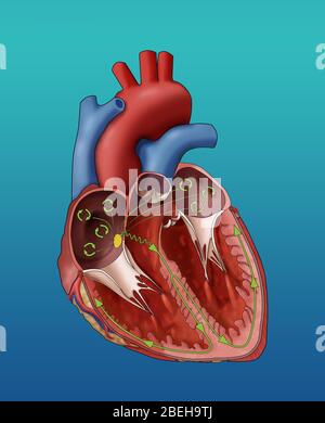Atrial Fibrillation, Illustration Stock Photo