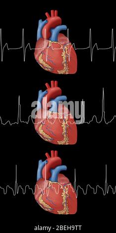 Heartbeat, AFib and Atrial Flutter, Illustration Stock Photo