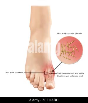 Gout in Foot, Illustration Stock Photo