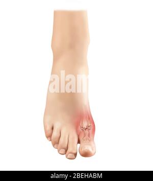 Gout in Foot, Illustration Stock Photo