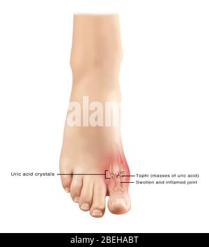 Gout in Foot, Illustration Stock Photo