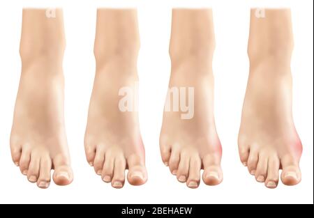 Gout in Foot, Illustration Stock Photo