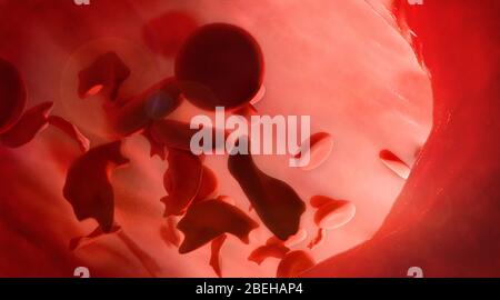 Sickle-cell Disease Illustration Stock Photo