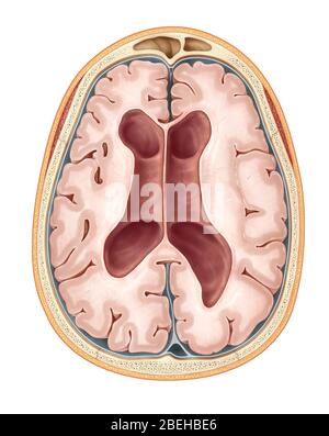 MRI Communicating Hydrocephalus (NPH) Stock Photo