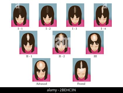 Stages of Female Hair Loss Stock Photo