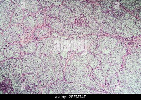 Cancer of the ovary diseased tissue under the microscope 100x Stock Photo