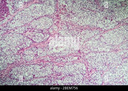 Cancer of the ovary diseased tissue under the microscope 100x Stock Photo