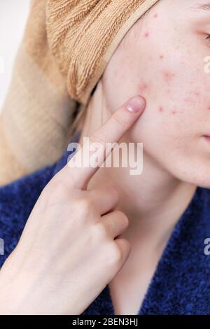 young millennial woman with problem skin Stock Photo