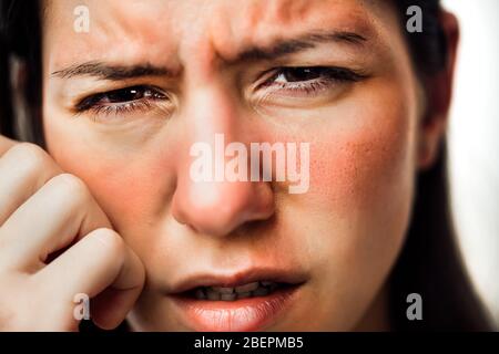 Woman with painful hot sunburn,facial skin redness problem,photosensitivity.Chemical burn,allergic reaction.Rosacea,dermatological condition,eczema Stock Photo
