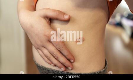 shingles on the children body close-up Stock Photo