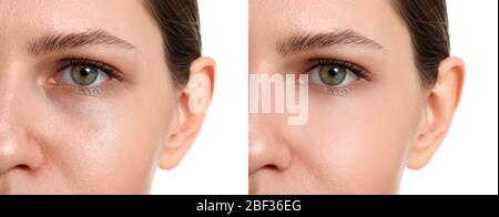 Woman before and after plastic surgery on white background Stock Photo
