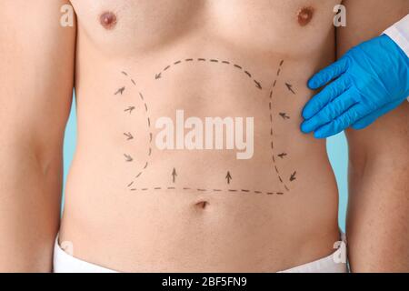 Young man with marks on his body, closeup. Concept of plastic