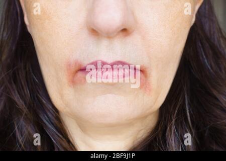 Perleche or perioral dermatitis: womans mouth with big red spots of inflamed skin around the corners. Stock Photo