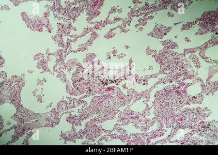 Lung tissue as dust lung under the microscope 100x Stock Photo