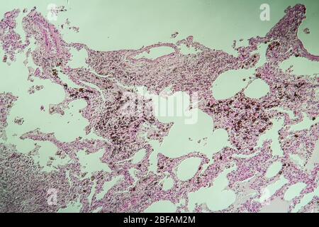 Lung tissue as dust lung under the microscope 100x Stock Photo