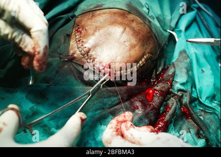 A neurosurgeon operating on a patient's brain closing the skin that covers the skin. Stock Photo