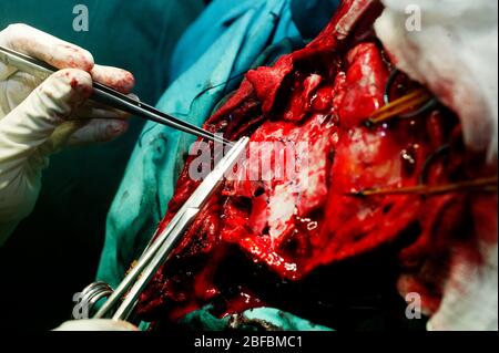 A neurosurgeon operating on a patient's brain starts to close the wound. Stock Photo