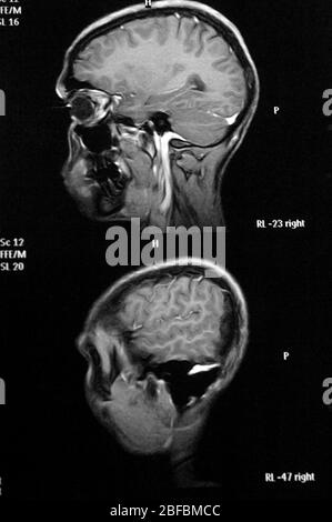 Multiple myeloma of the skull, X-ray Stock Photo - Alamy