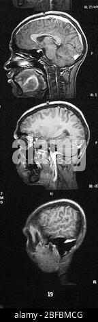 Multiple myeloma of the skull, X-ray Stock Photo - Alamy