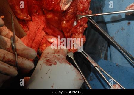 Clearing the Axilla from lymph nodes containing secondaries. (Mastectomy + Axillary Clearance) Stock Photo