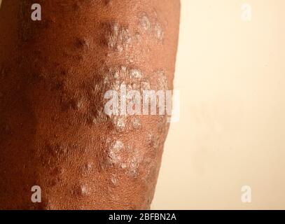 Arm with an unknown skin lesion. Stock Photo