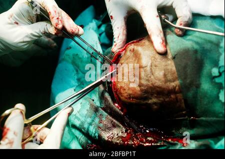 A neurosurgeon operating on a patient's brain starts to close the skin. Stock Photo