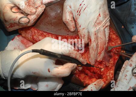 Clearing the Axilla from lymph nodes containing secondaries. (Mastectomy + Axillary Clearance) Stock Photo