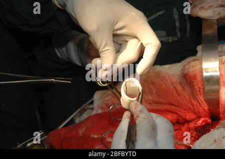 Surgeons suture a dacron graft to the aorta to repair an ascending aortic aneurysm. Stock Photo