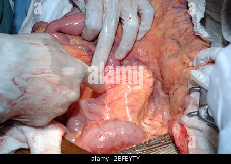 Close up of the aneurysmal sac Stock Photo