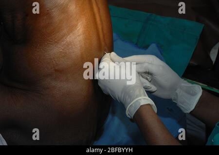 Anaesthetist introducing the spinal needle. Stock Photo