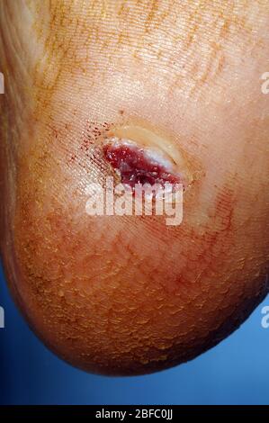 Abscess on the heel of 6 year old male. Stock Photo